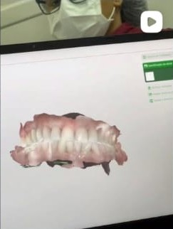 Modelo 3D de arcada dentária na tela após escaneamento digital