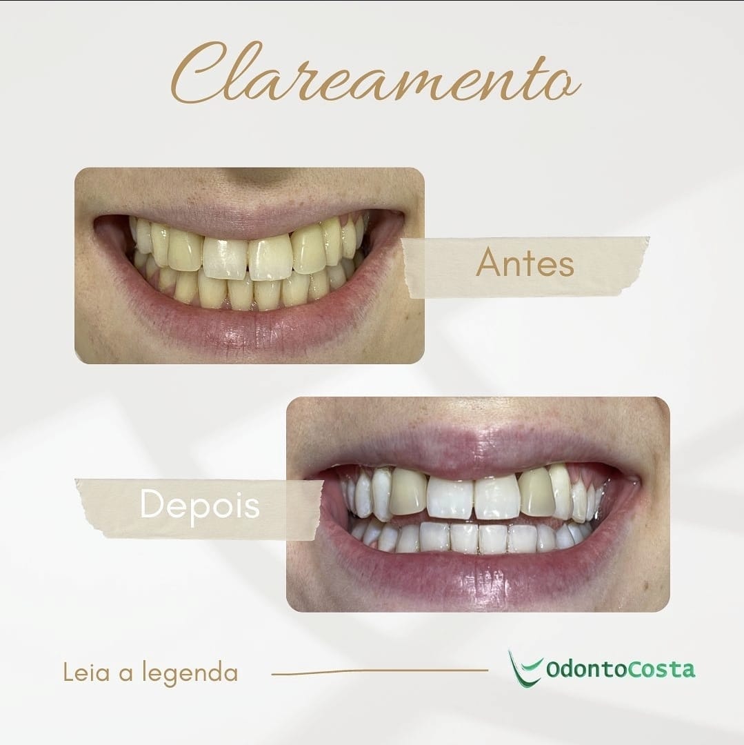 Antes e depois – Clareamento